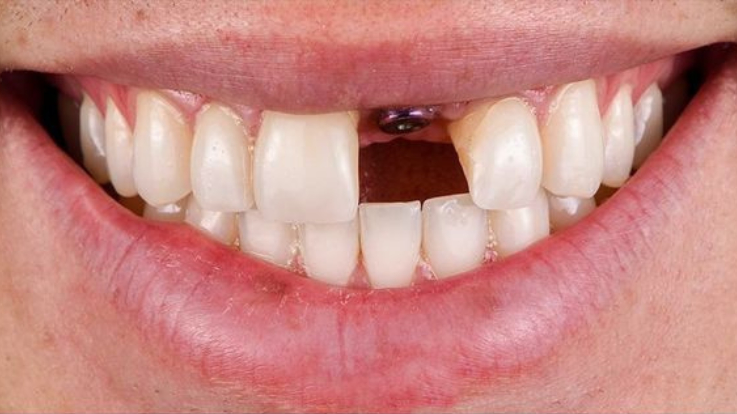 Before - Single Tooth Implant