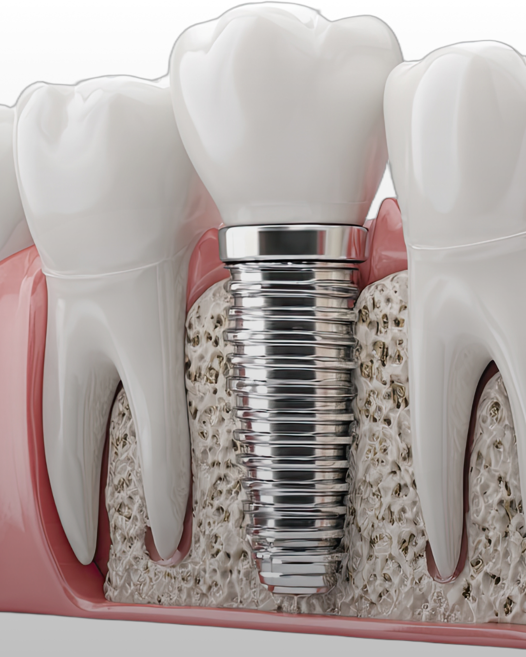 Dental Implants