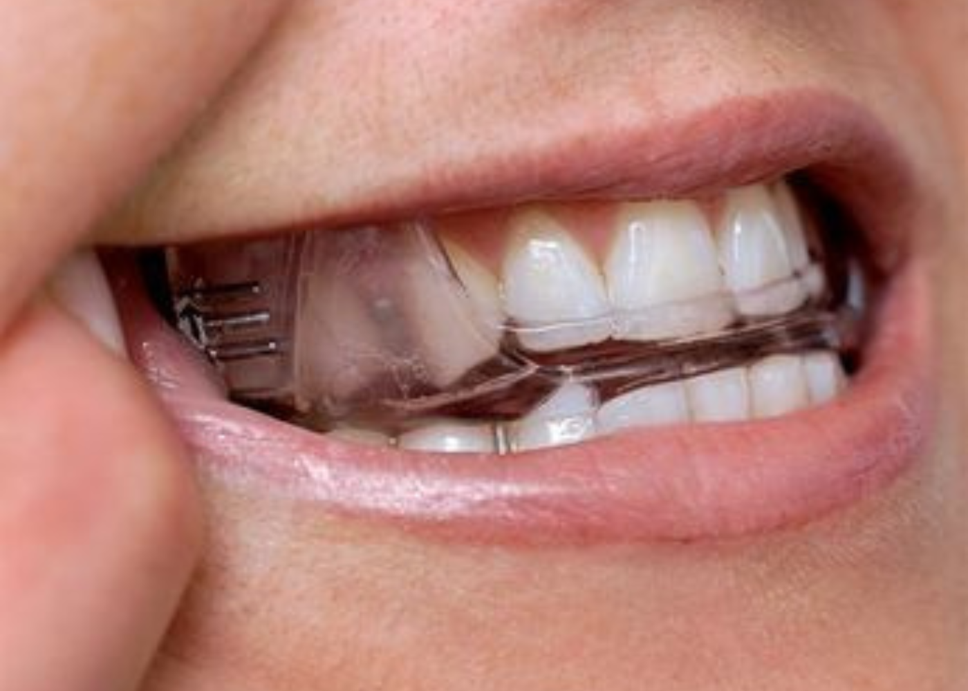 Oral Appliance Therapy