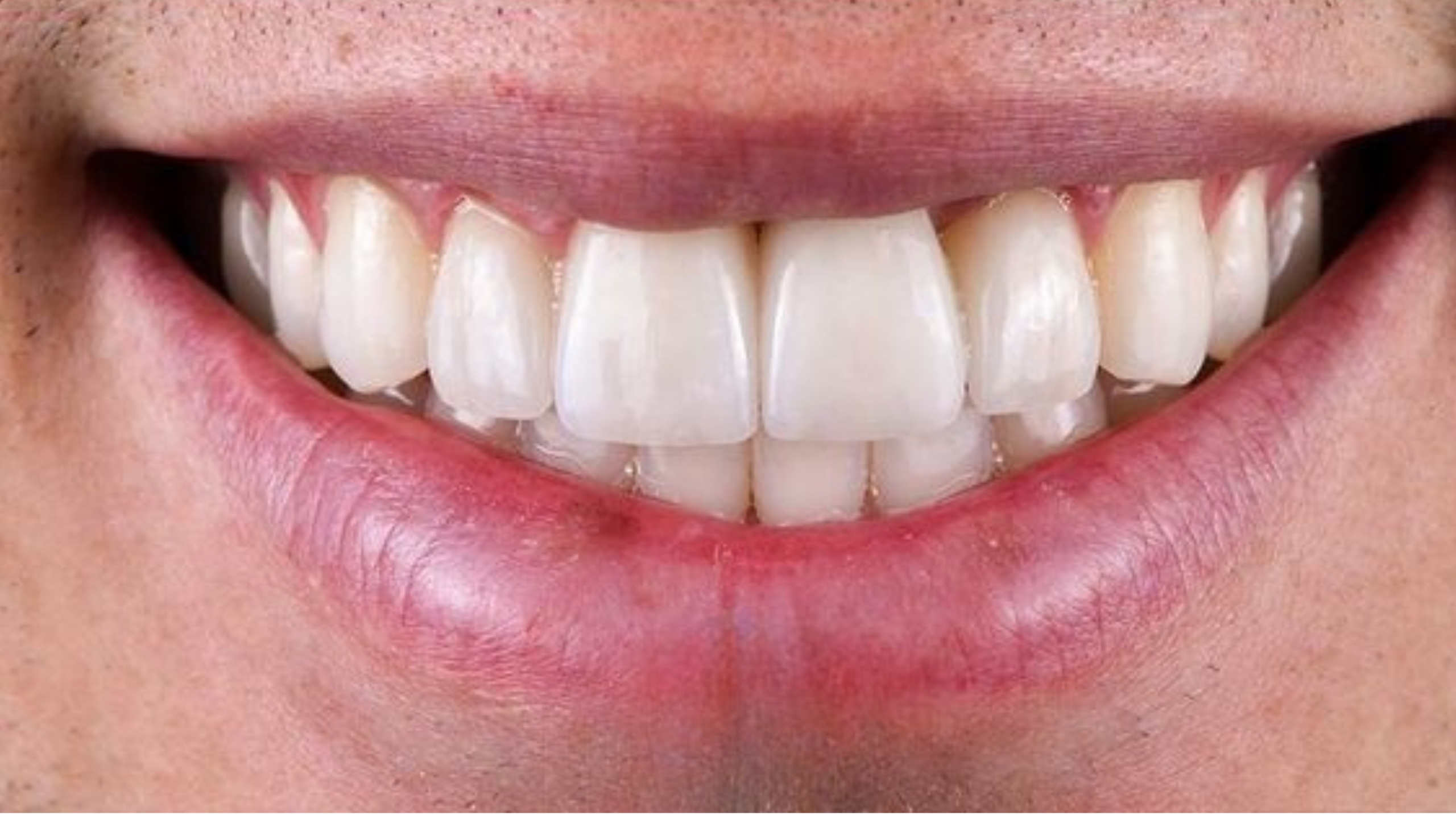 After - Single Tooth Implant