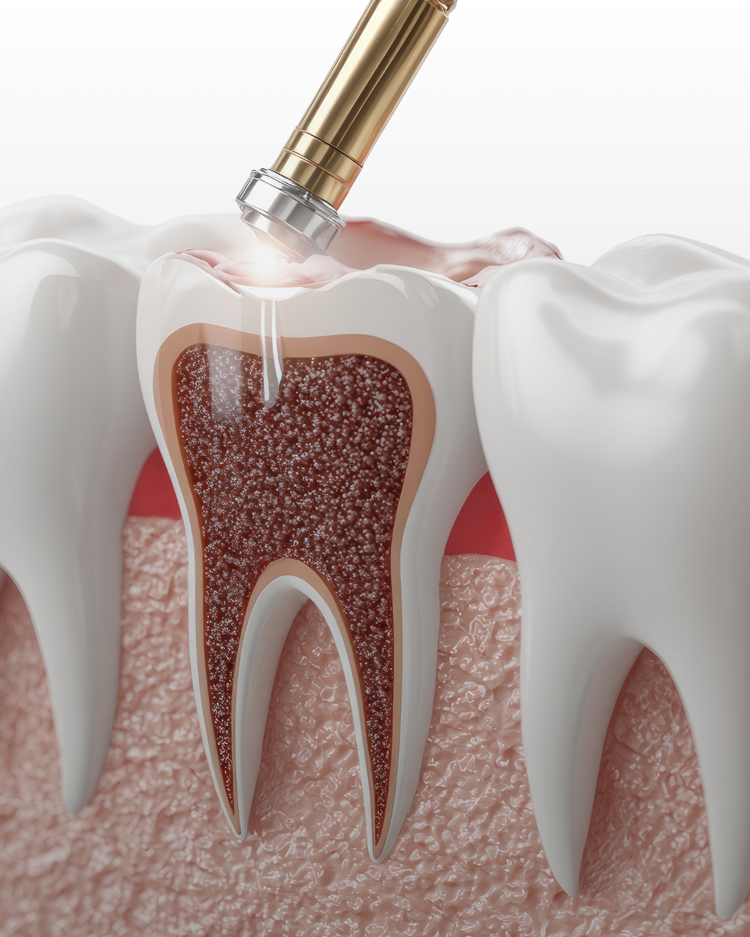Root Canal Treatment
