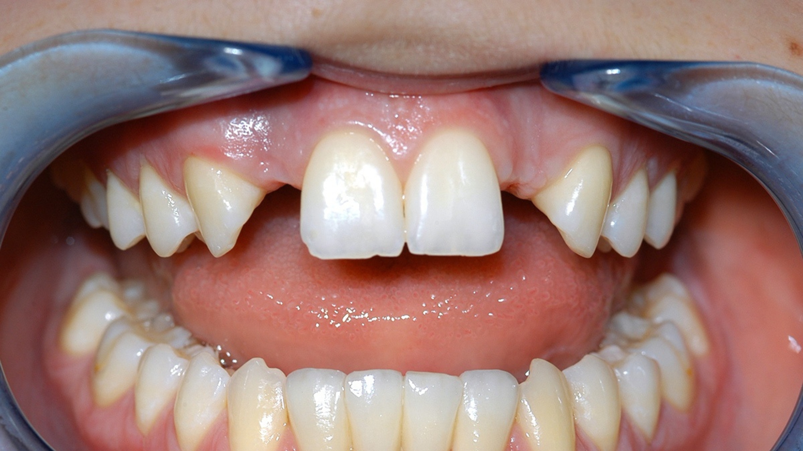 Before - Multiple Implants