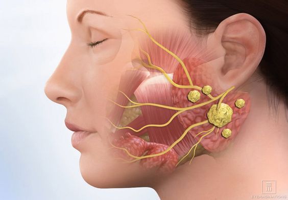 Salivary Stone Removal