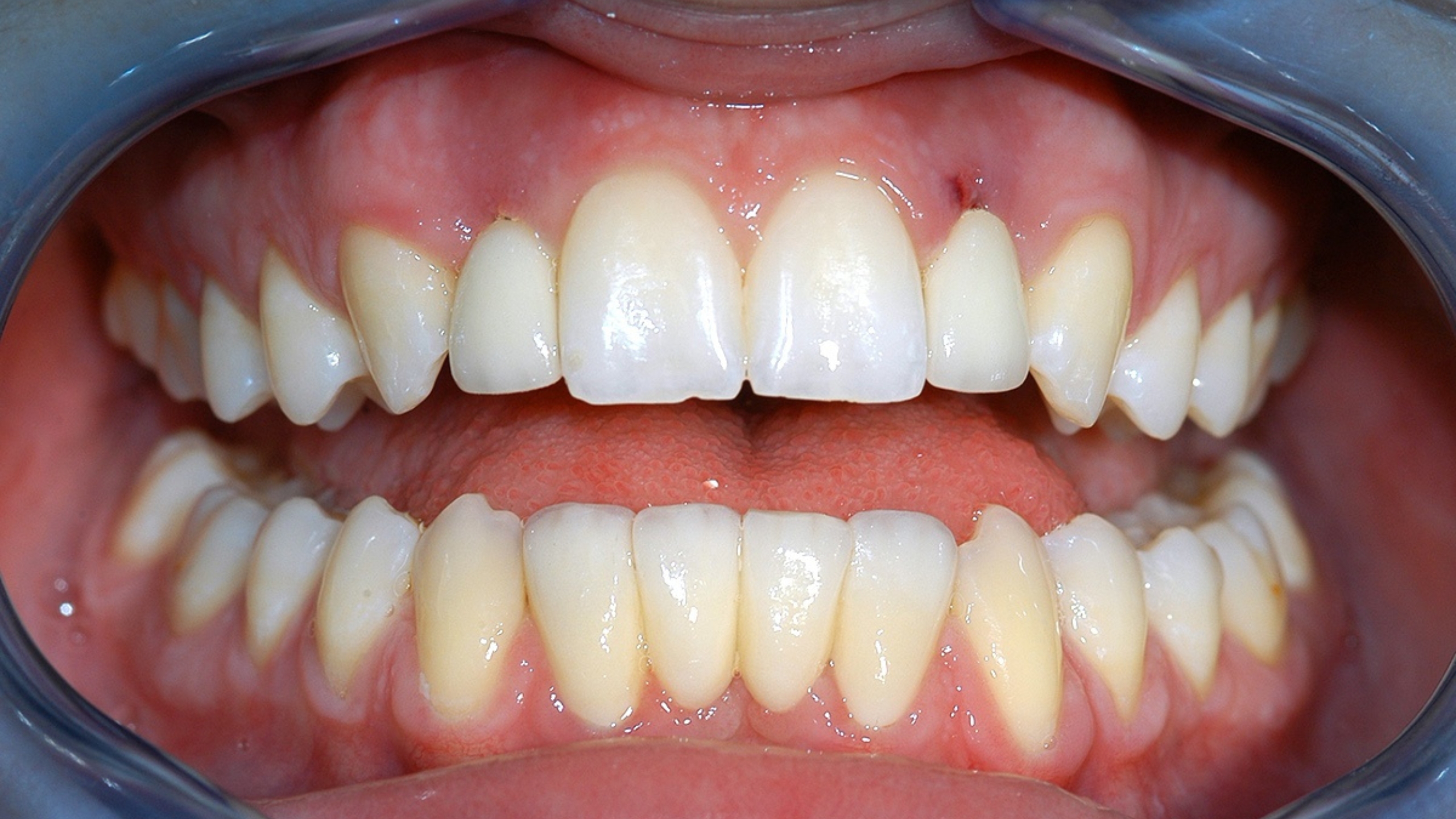 After - Multiple Implants