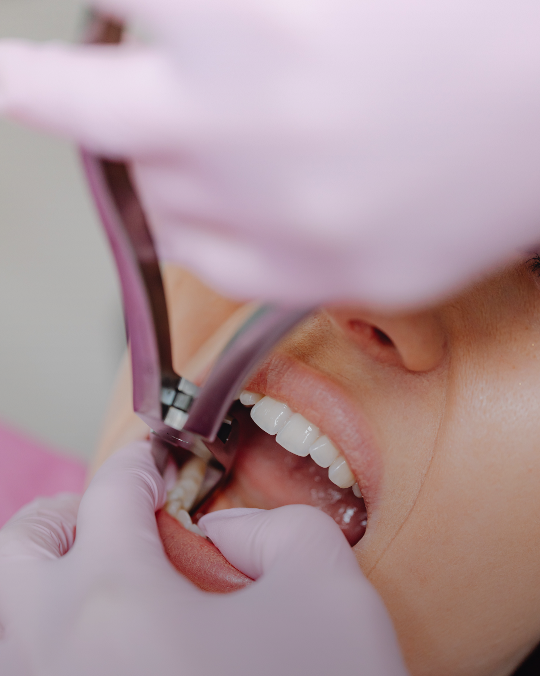 Wisdom Tooth Extraction