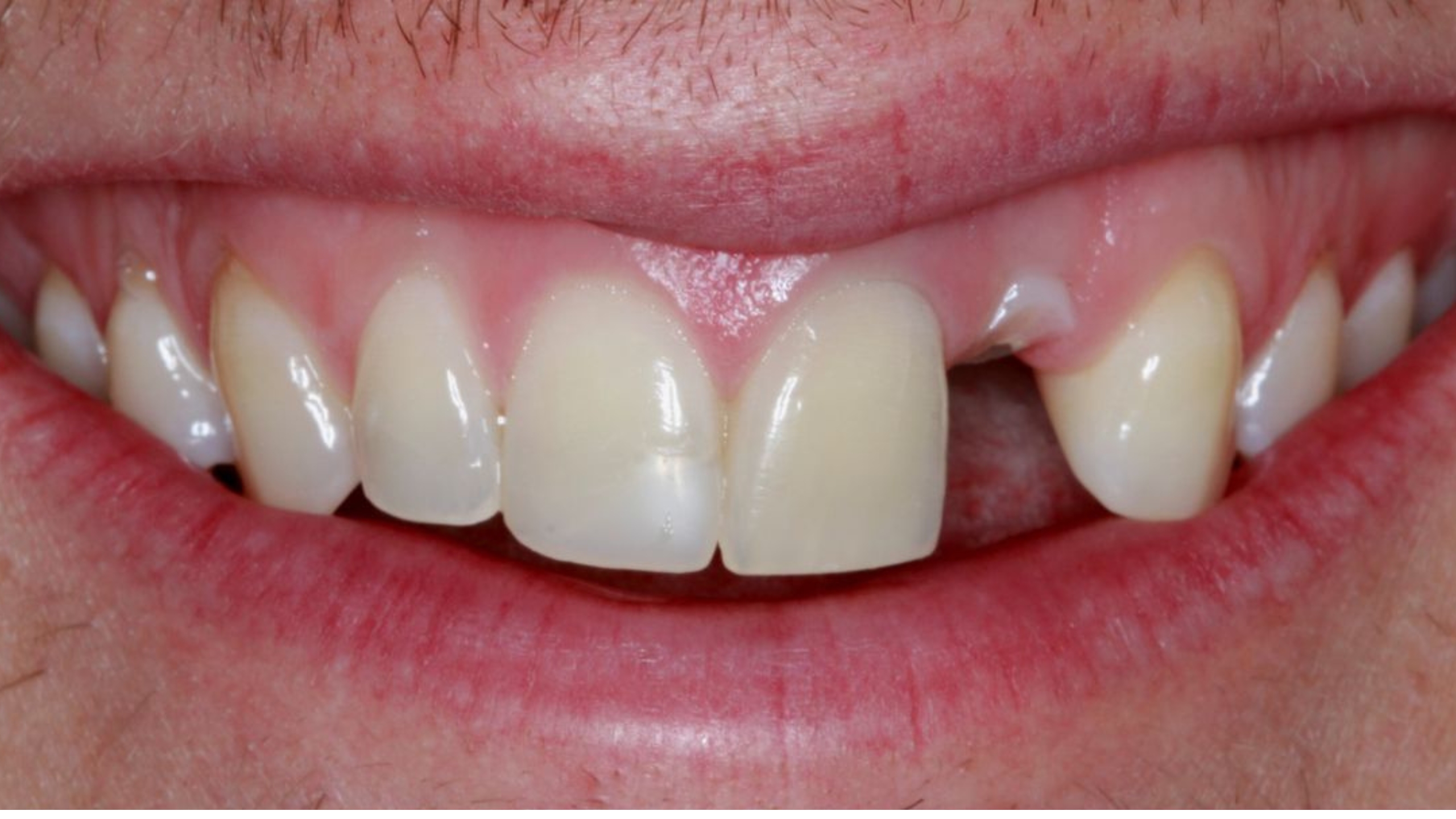 Before - Front Tooth Implant