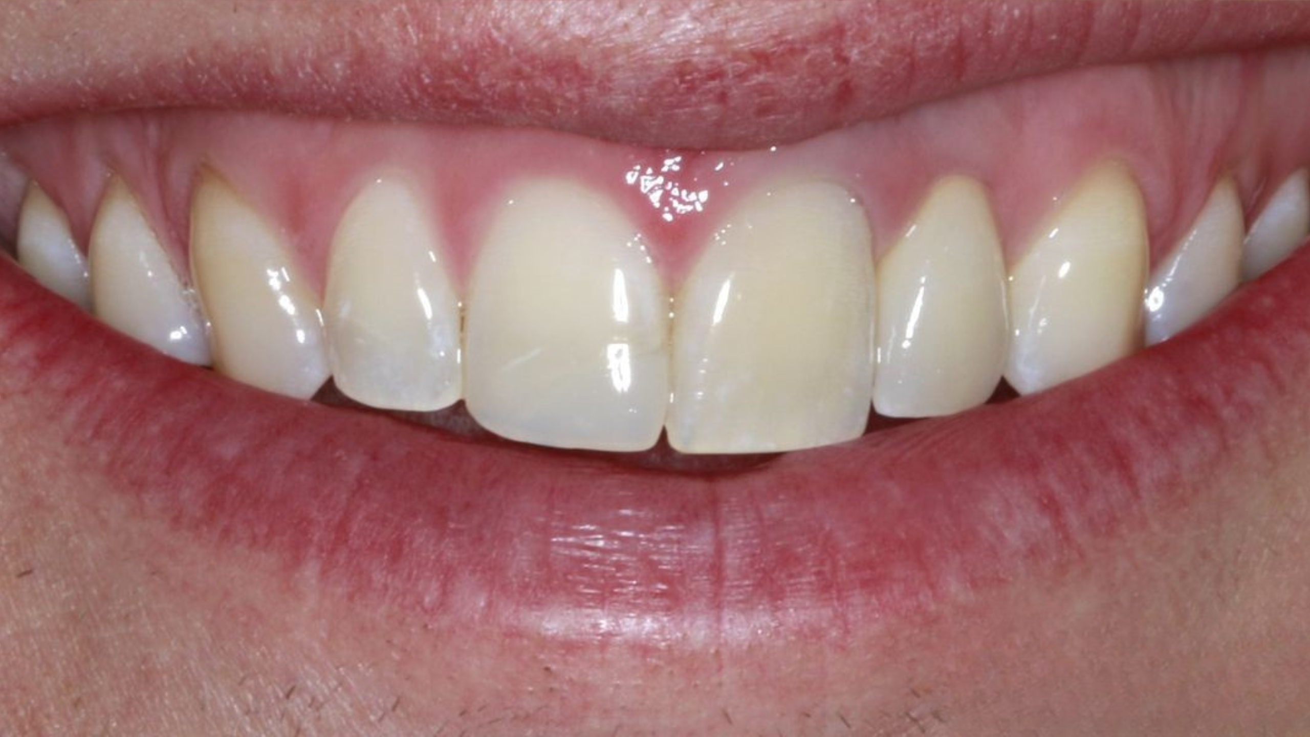 After - Front Tooth Implant