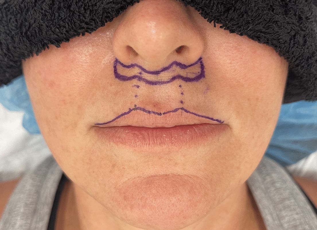 Bullhorn Lip Lift