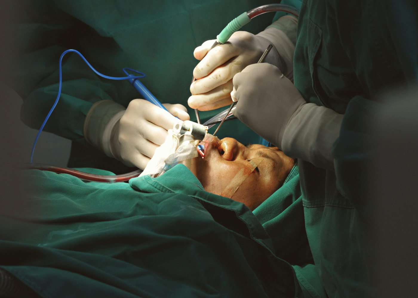 Odontogenic Cyst Removal (Jaw Cysts)