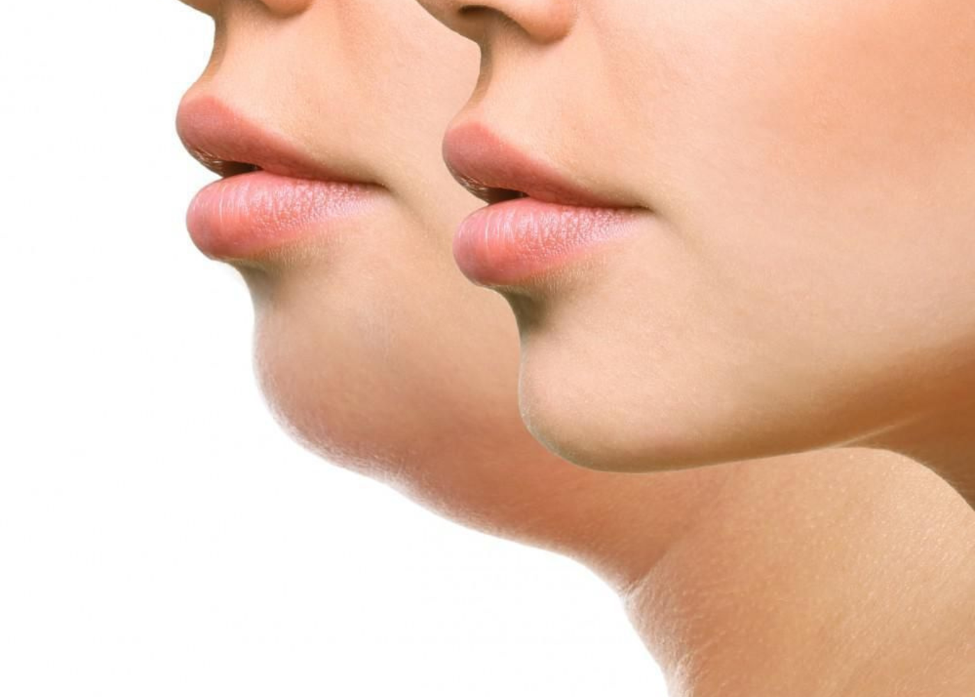 Cryolipolysis for Sculpting in Bangalore