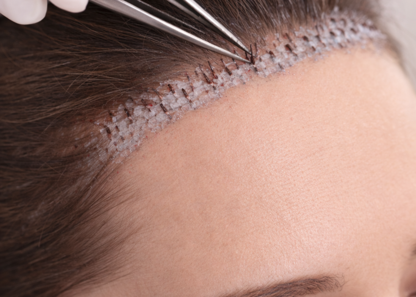 Hairline Lowering with Hair Grafting in Bangalore