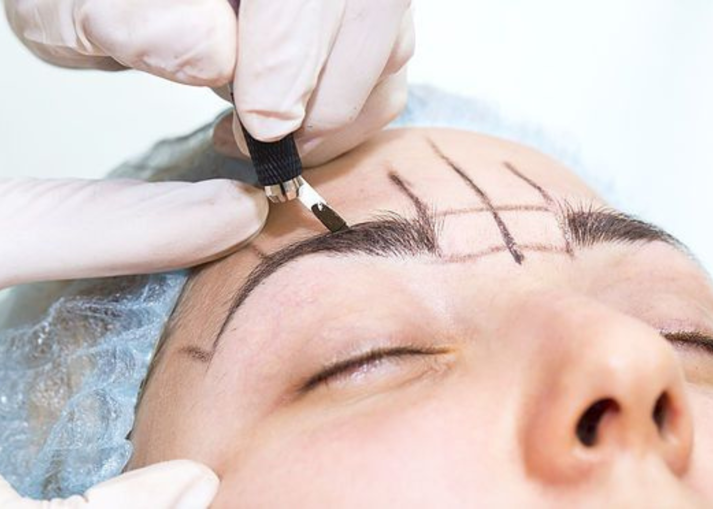 Eyebrow Hair Transplant