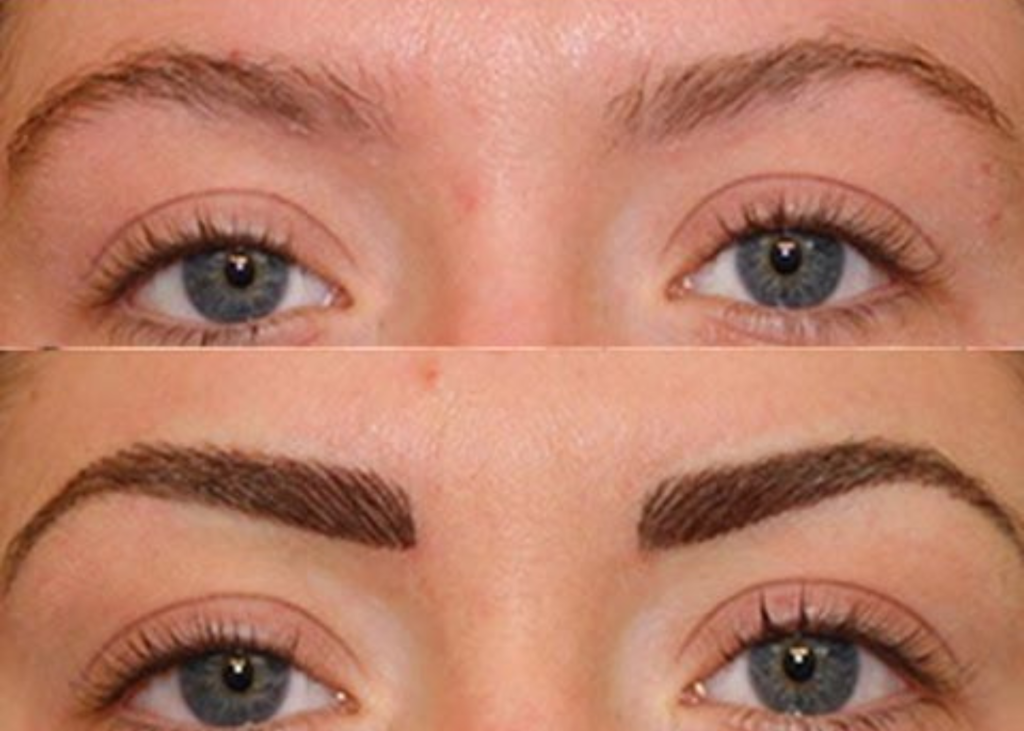 Eyebrow Hair Transplant Before and After