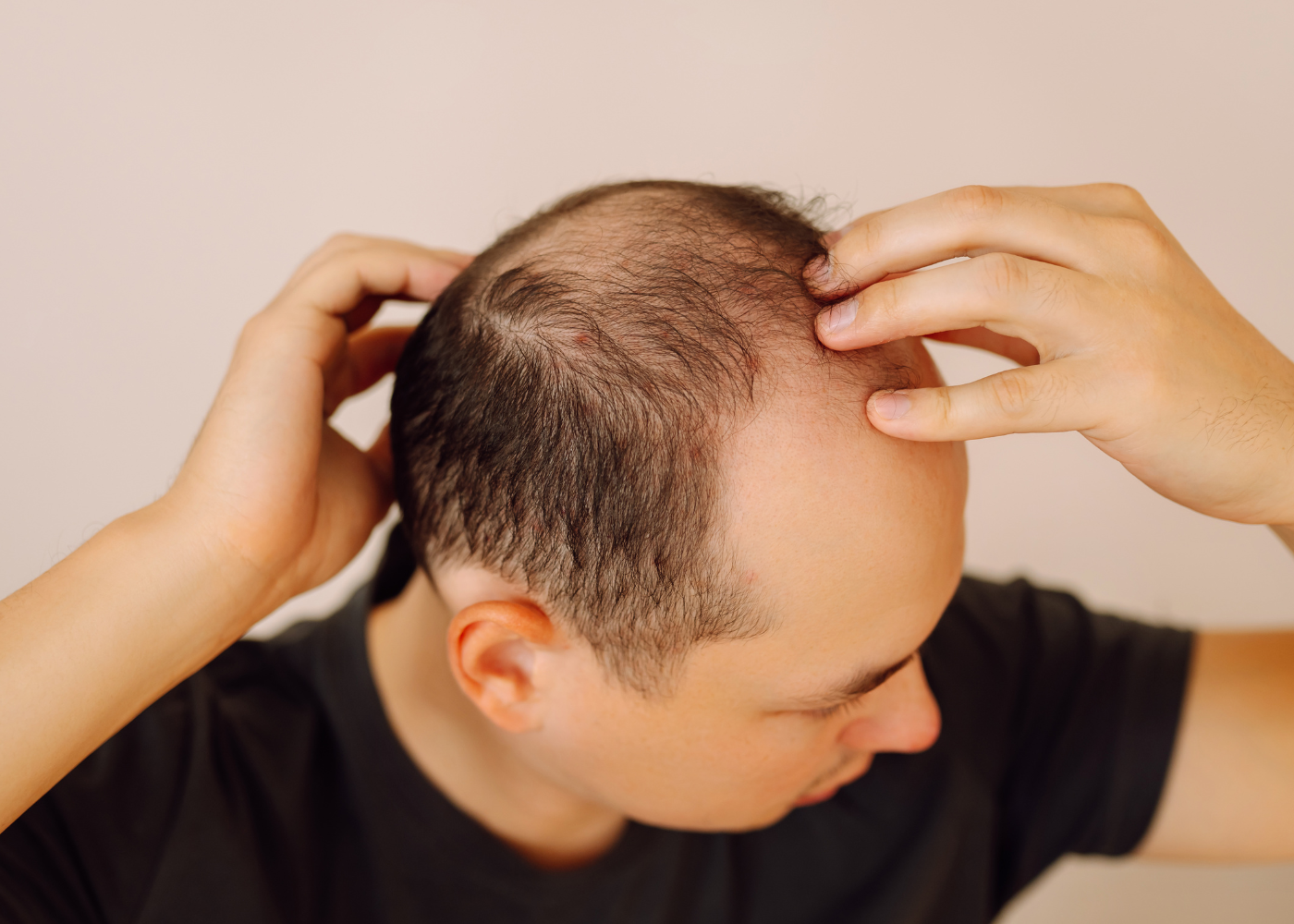 Hair loss Treatment in Bangalore