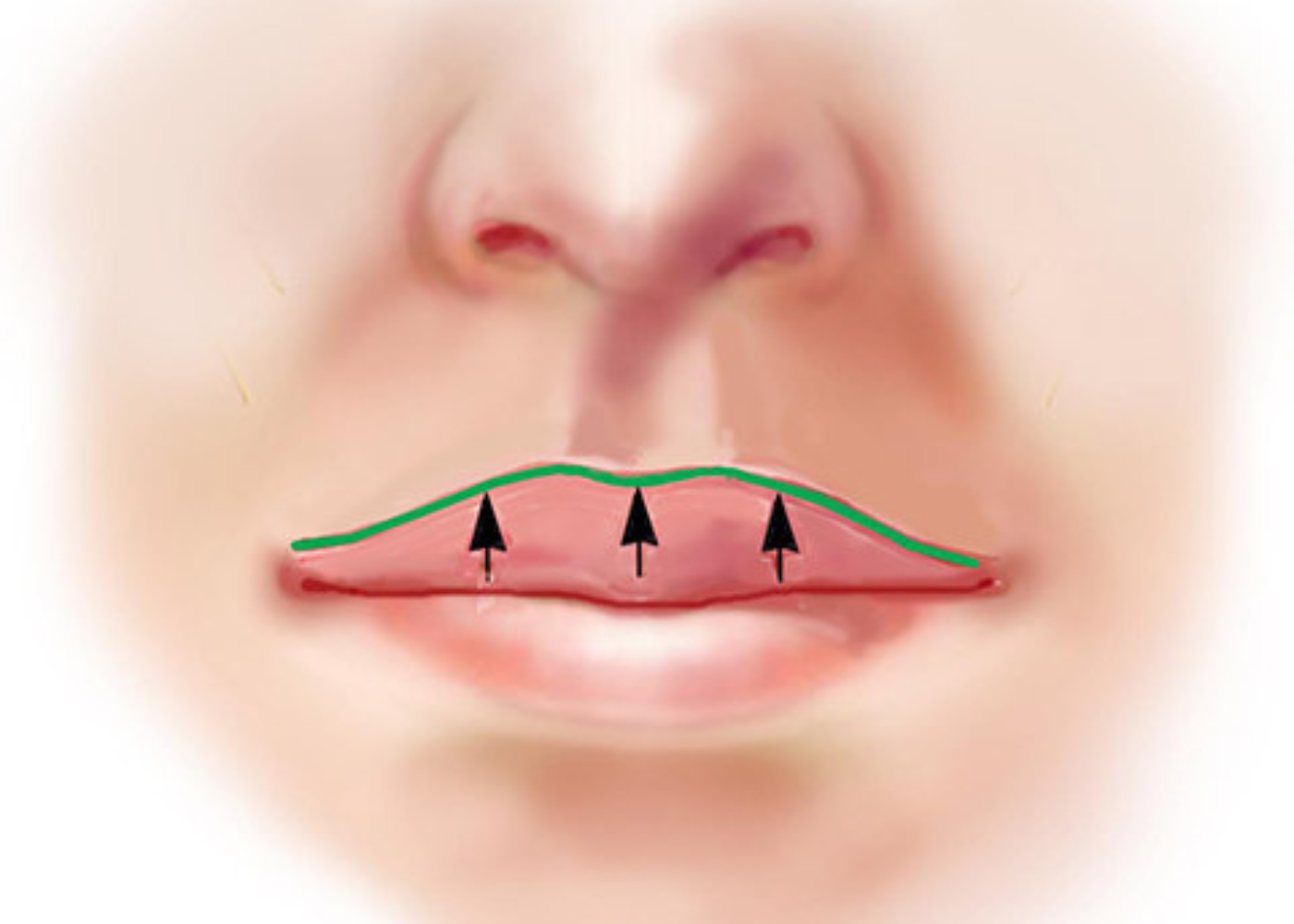 Italian Lip Lift (Minimally Invasive)