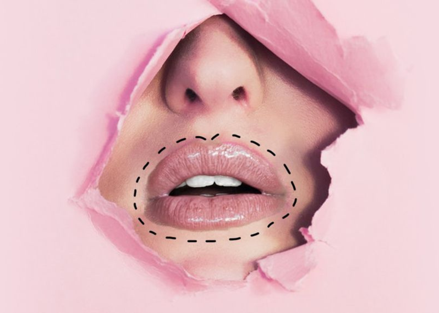 What is Lip Debulking Surgery?
