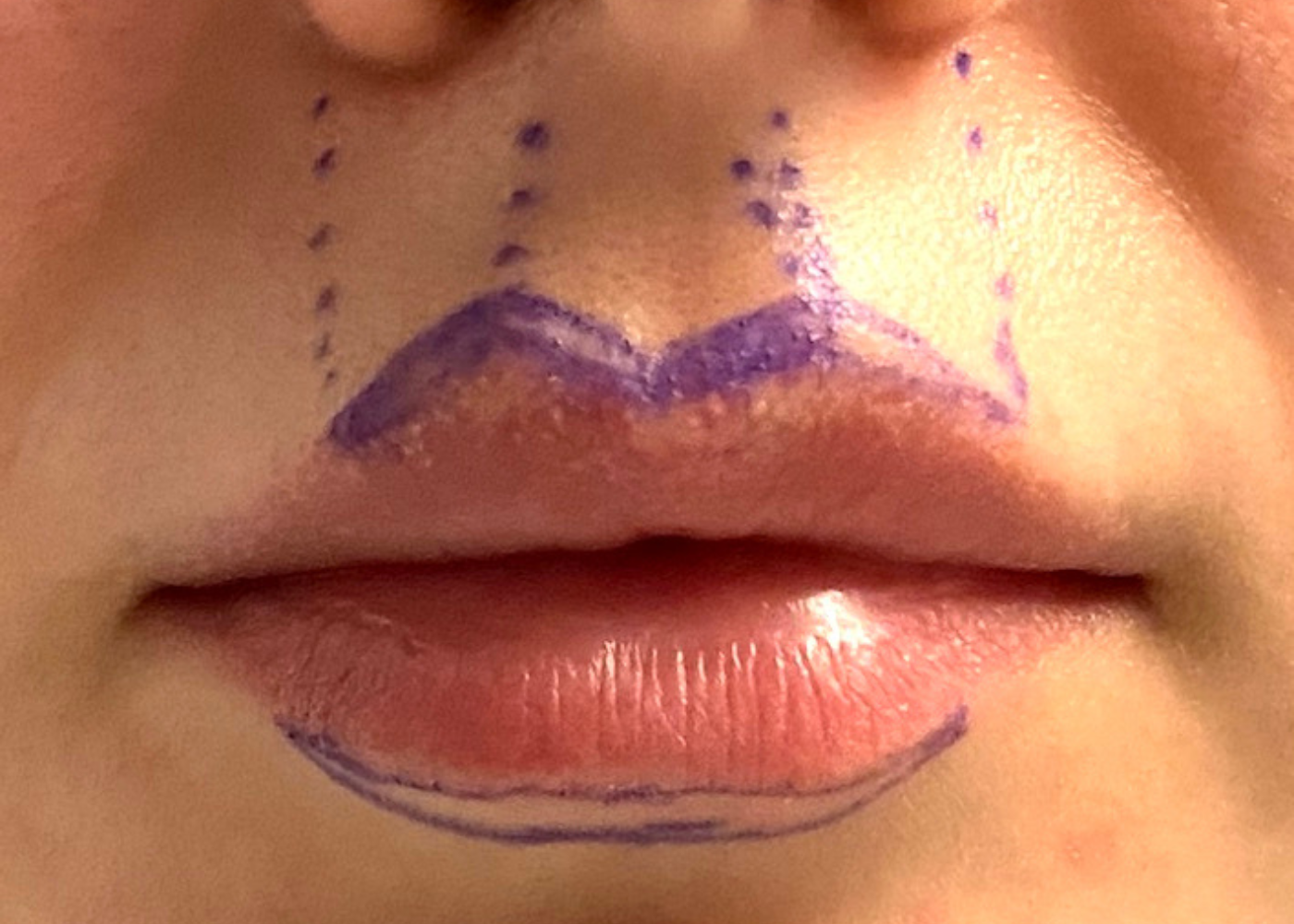 Combined Lip Debulking (Upper & Lower)