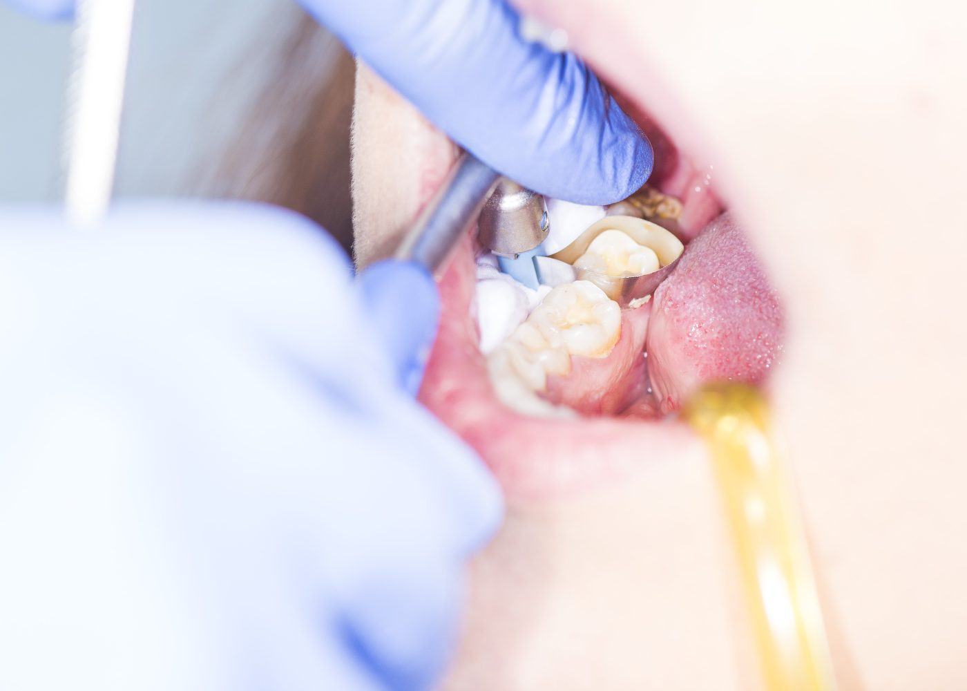 Simple Tooth Extraction