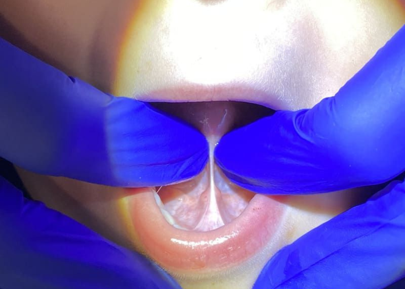 Tongue Tie Surgery