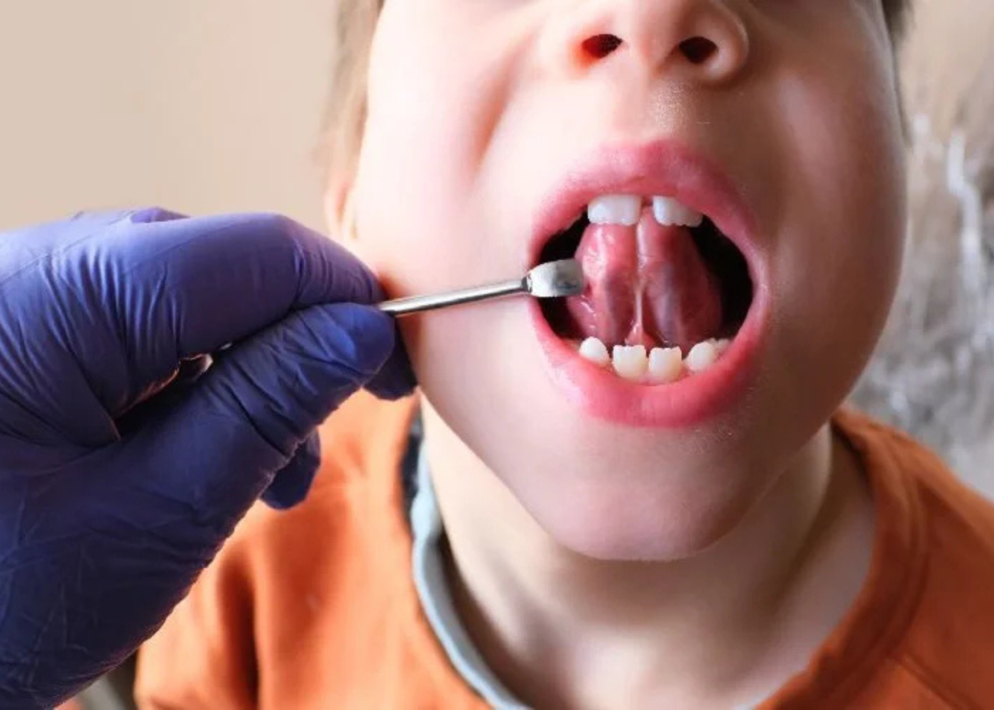 What is Tongue Tie Surgery?