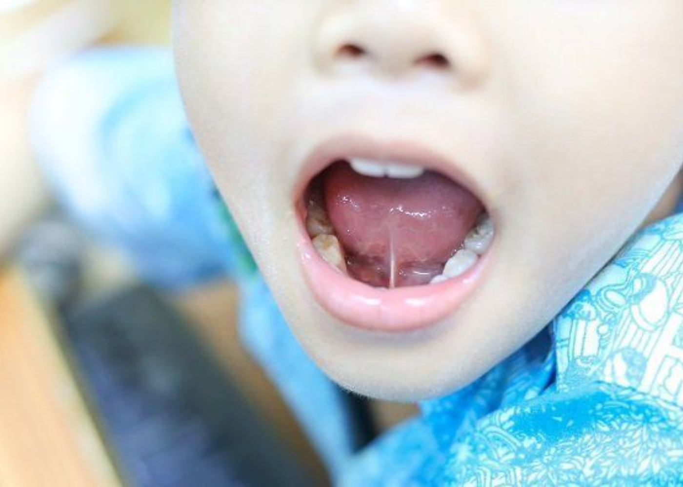 Frenotomy (Simple Release Procedure)