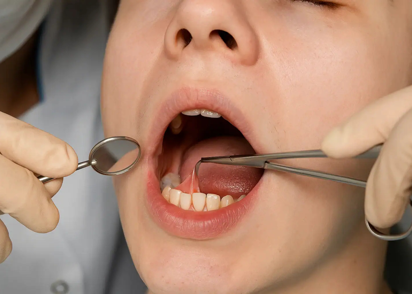 Frenectomy (Complete Tissue Removal)