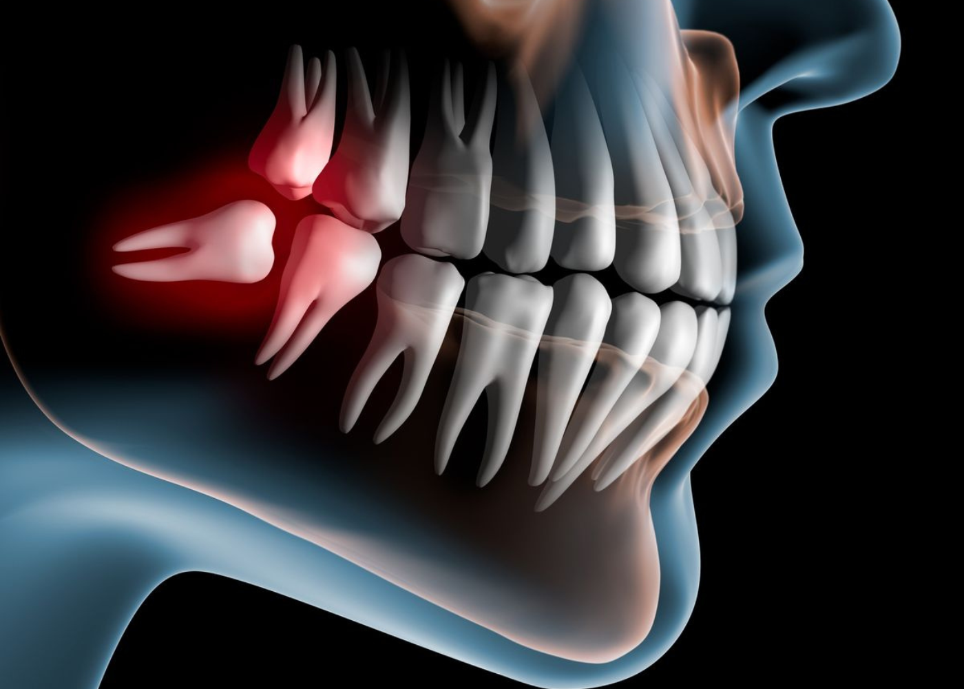 What is Dental Cyst Removal?