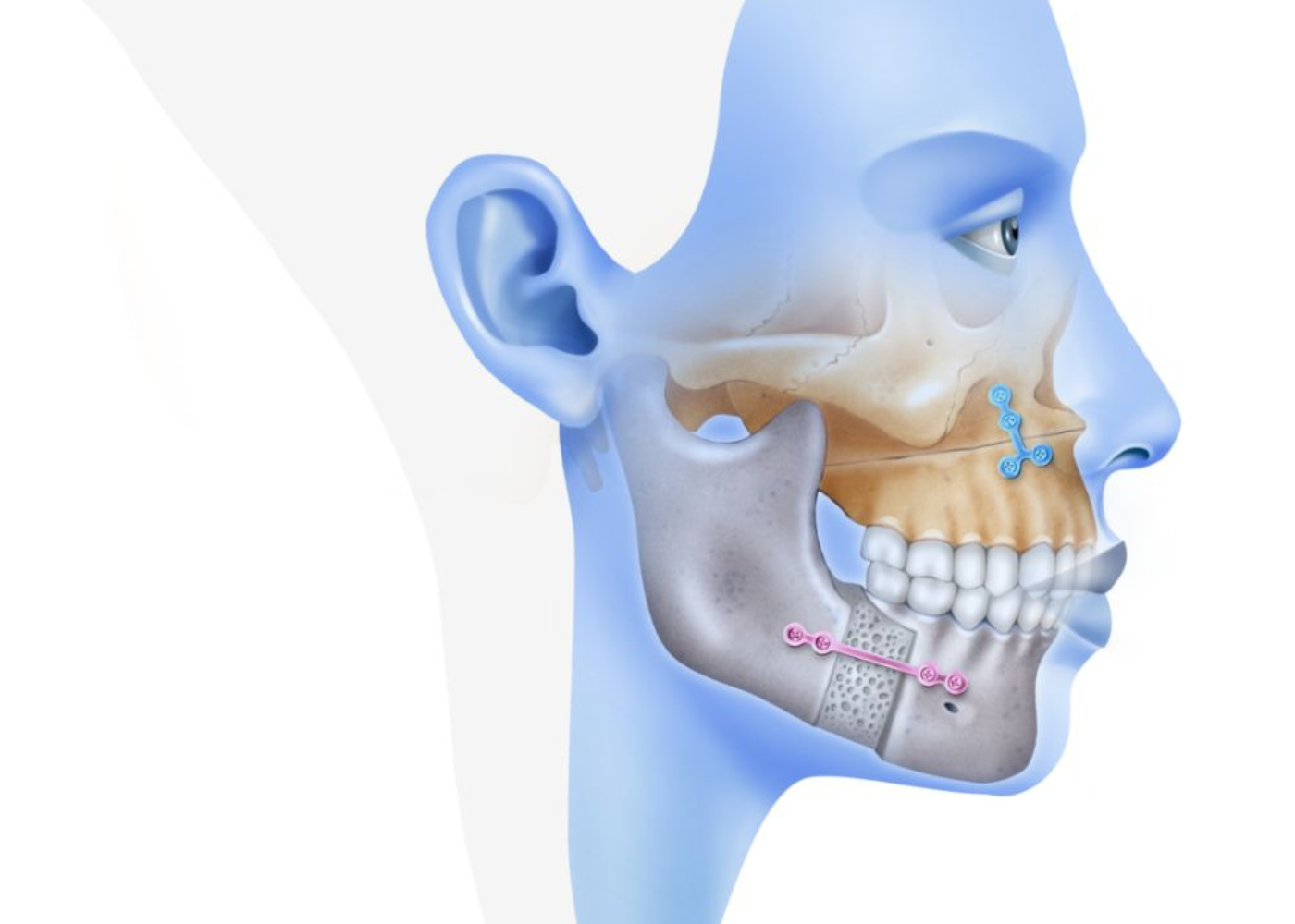 What is Orthognathic Surgery?