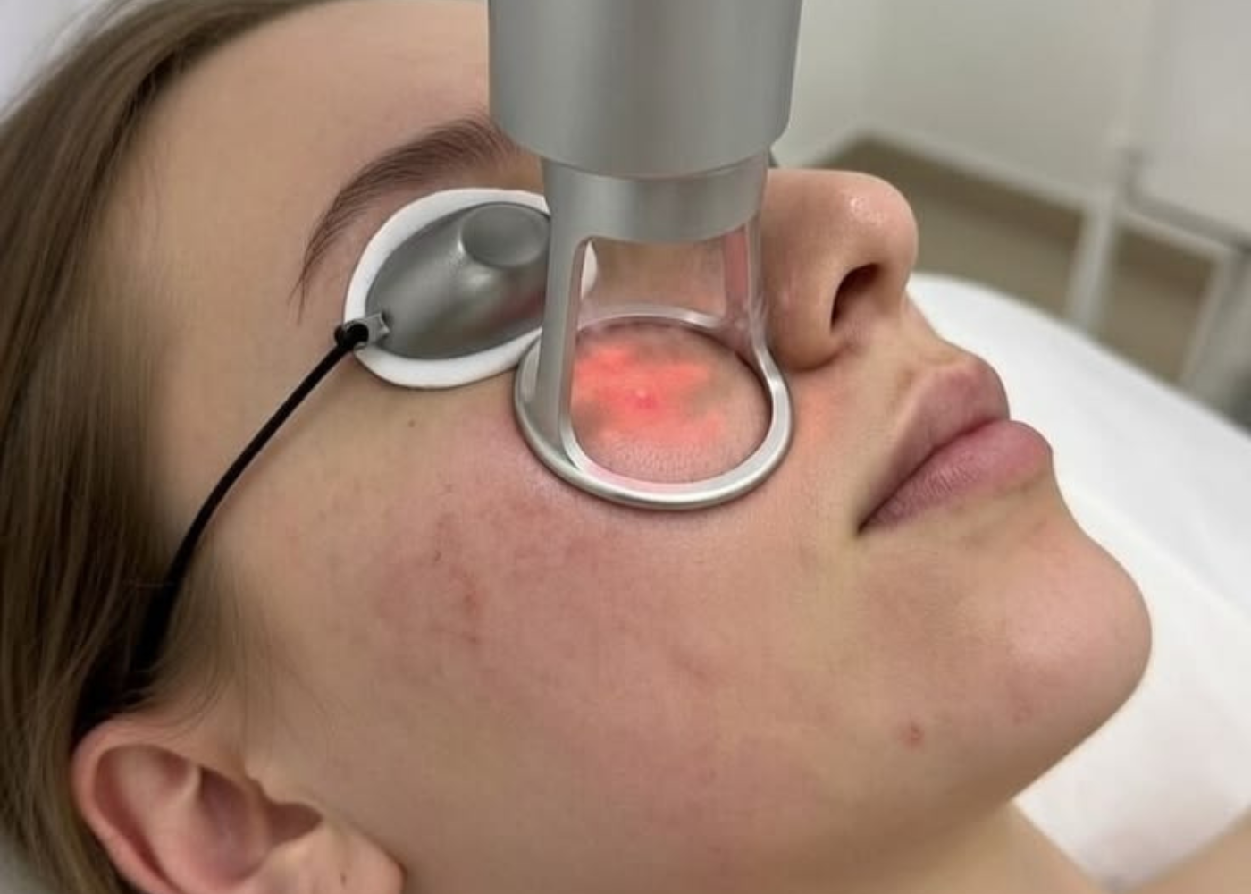 CO2 Fractional Laser in Bangalore