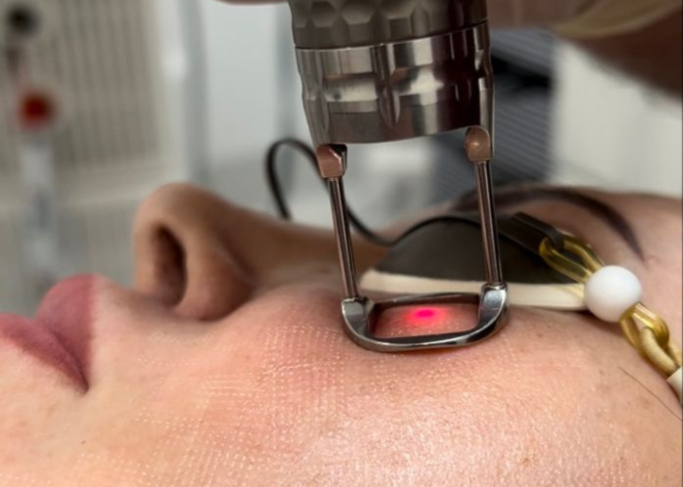 What is Scar Correction & CO2 Fractional Laser Treatment?