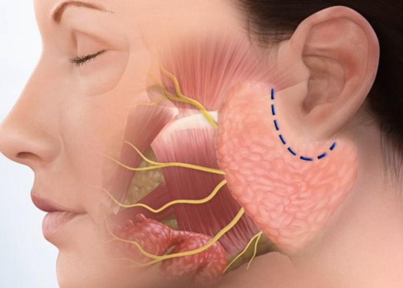 Salivary Gland Surgery