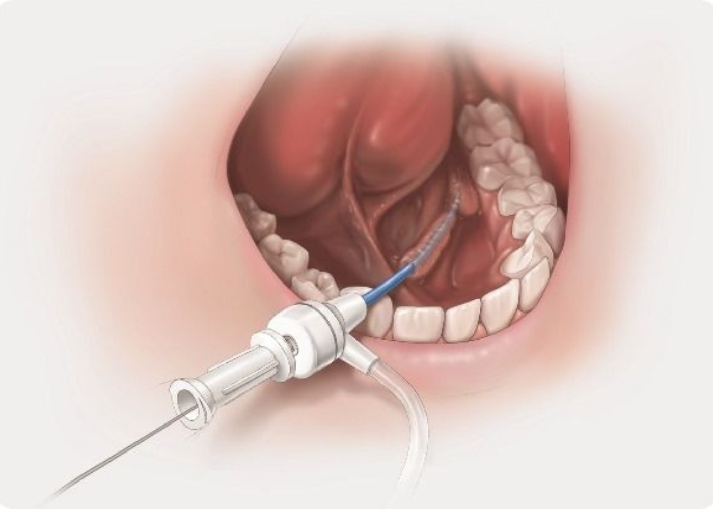 What is Salivary Gland Surgery?