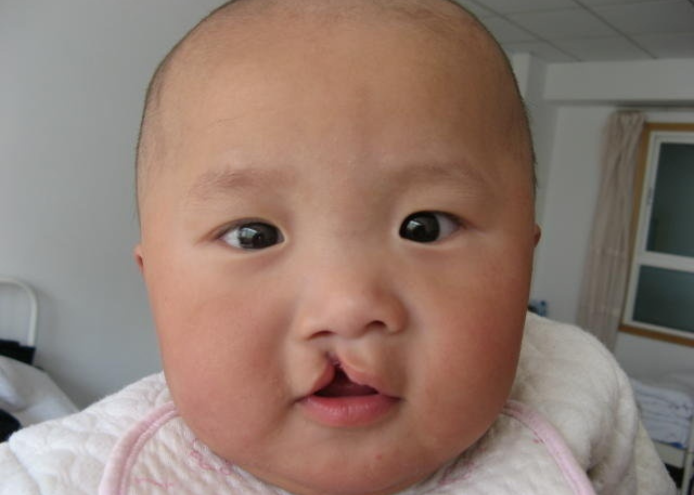 Orofacial Cleft Surgery
