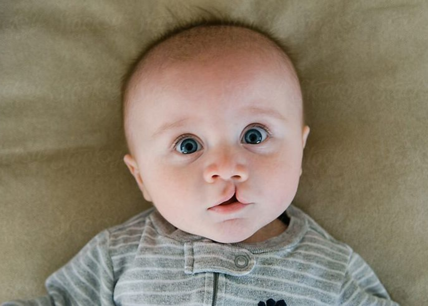 What is Orofacial Cleft Surgery?