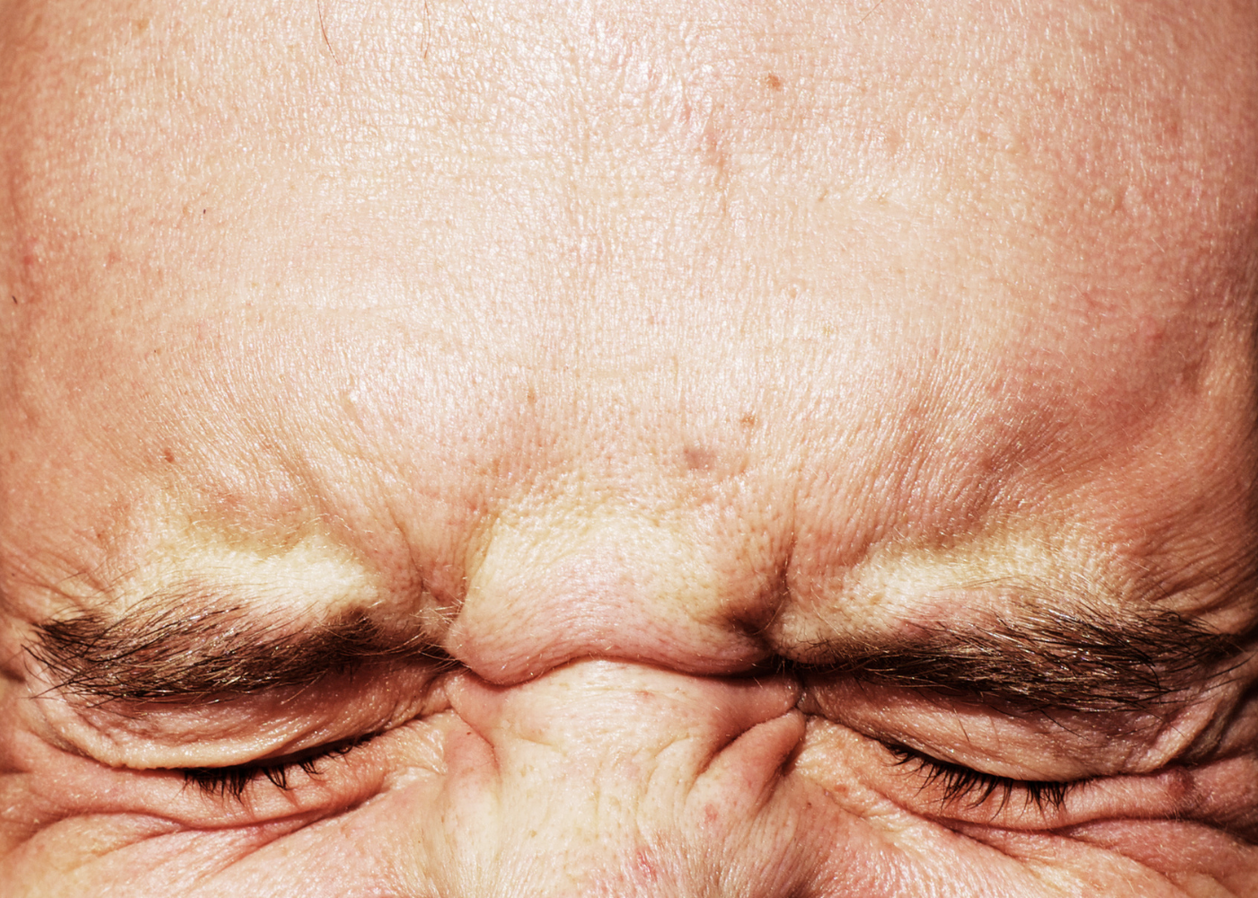 Forehead Reduction Surgery in Bangalore