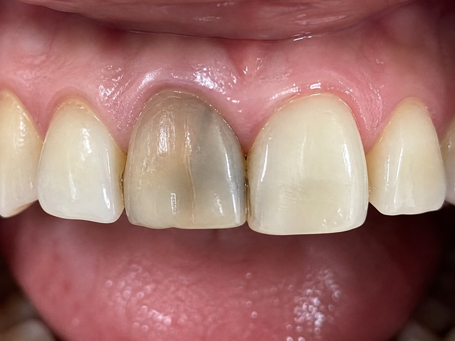 Before - Front Tooth RCT
