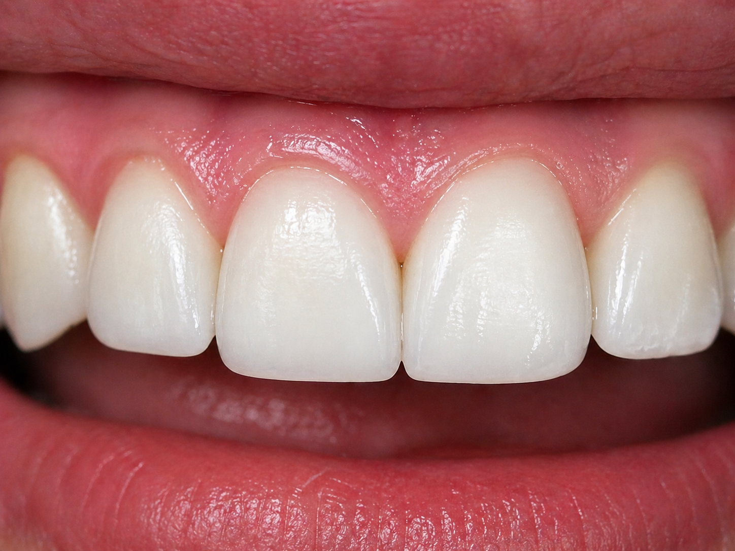 After - Front Tooth RCT